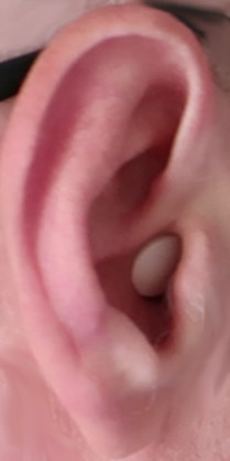 earplug-normal-insertion