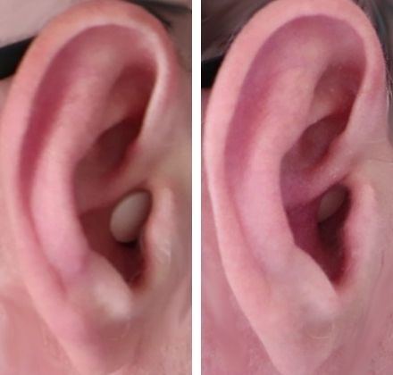 earplugs-normal-vs-deep-insertion