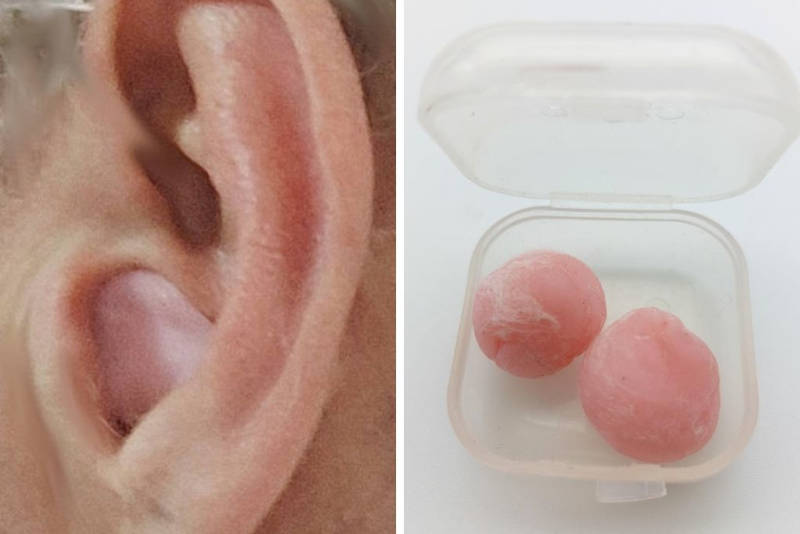 Ohropax-wax at the ear canal entrance